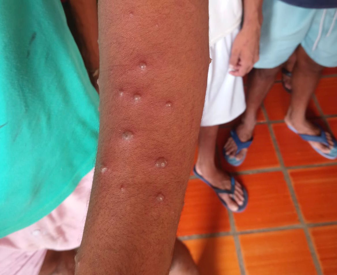 Internos de la Permanente Central de Policía en Valledupar presentan brote de varicela 